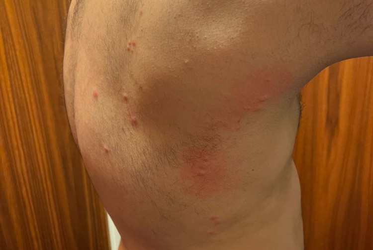 Man's with rashes and bites on his torso due to poor hygiene standards in the accommodation